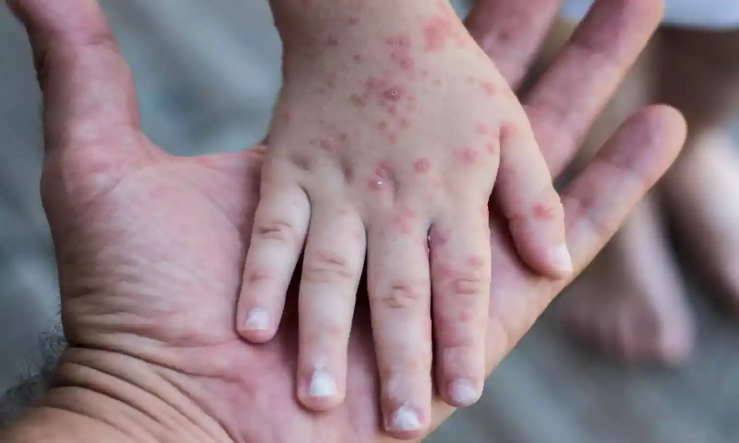 Disease control