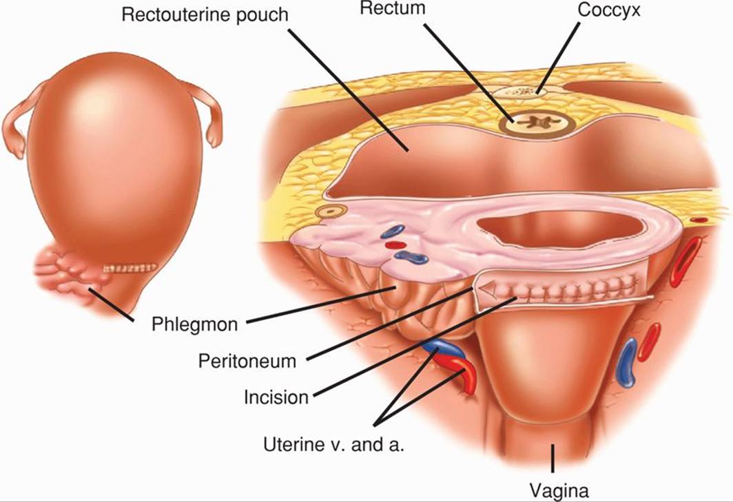 Puerperal Sepsis