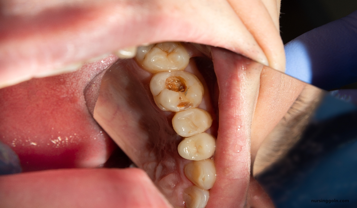 Dental caries | CHAPTER-10 | Medical and Surgical Nursing