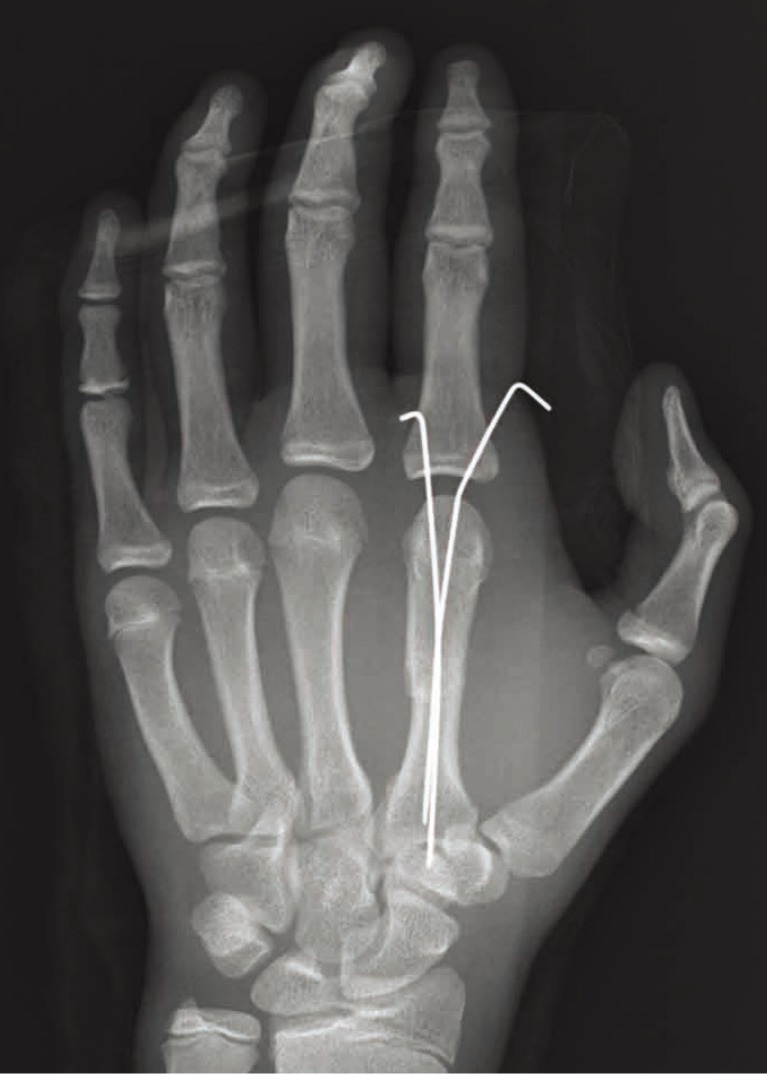 Definition of K-wire
