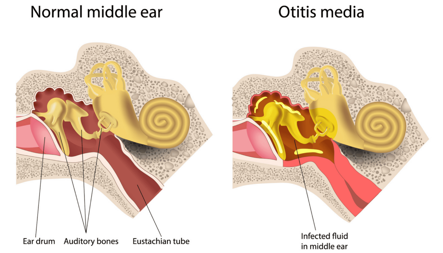Definition of Otitis media