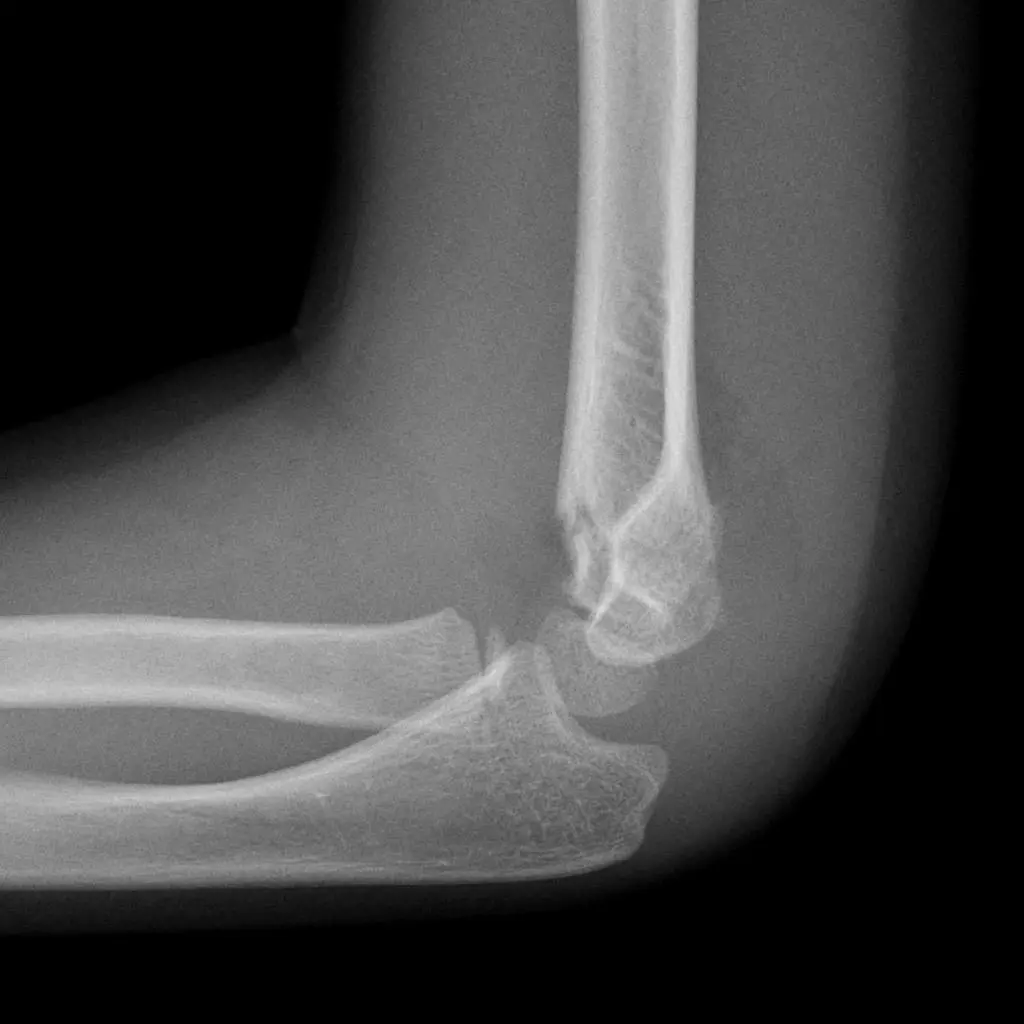 Fracture of radius & Ulna | CHAPTER 5 | Orthopedic Nursing