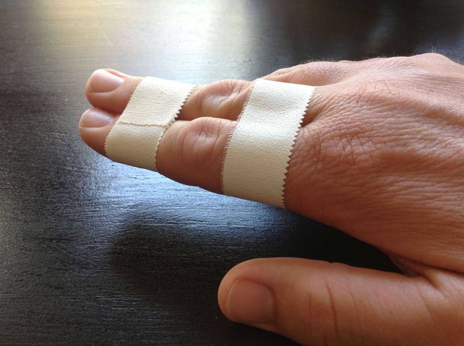 Interphalangeal joint dislocation | CHAPTER 6 | Orthopedic Nursing