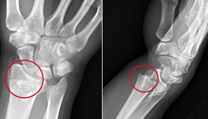 Colles fracture | CHAPTER 5 | Orthopedic Nursing