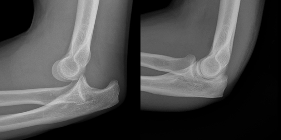 Elbow Dislocation | CHAPTER 6 | Orthopedic Nursing