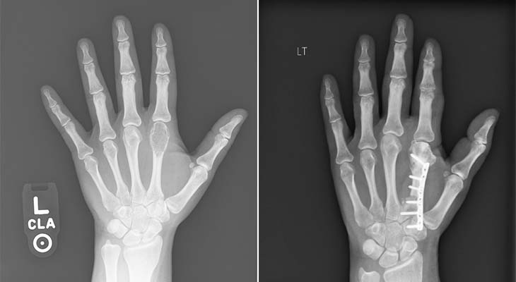 Giant Cell Tumor | CHAPTER 16 | Orthopedic Nursing