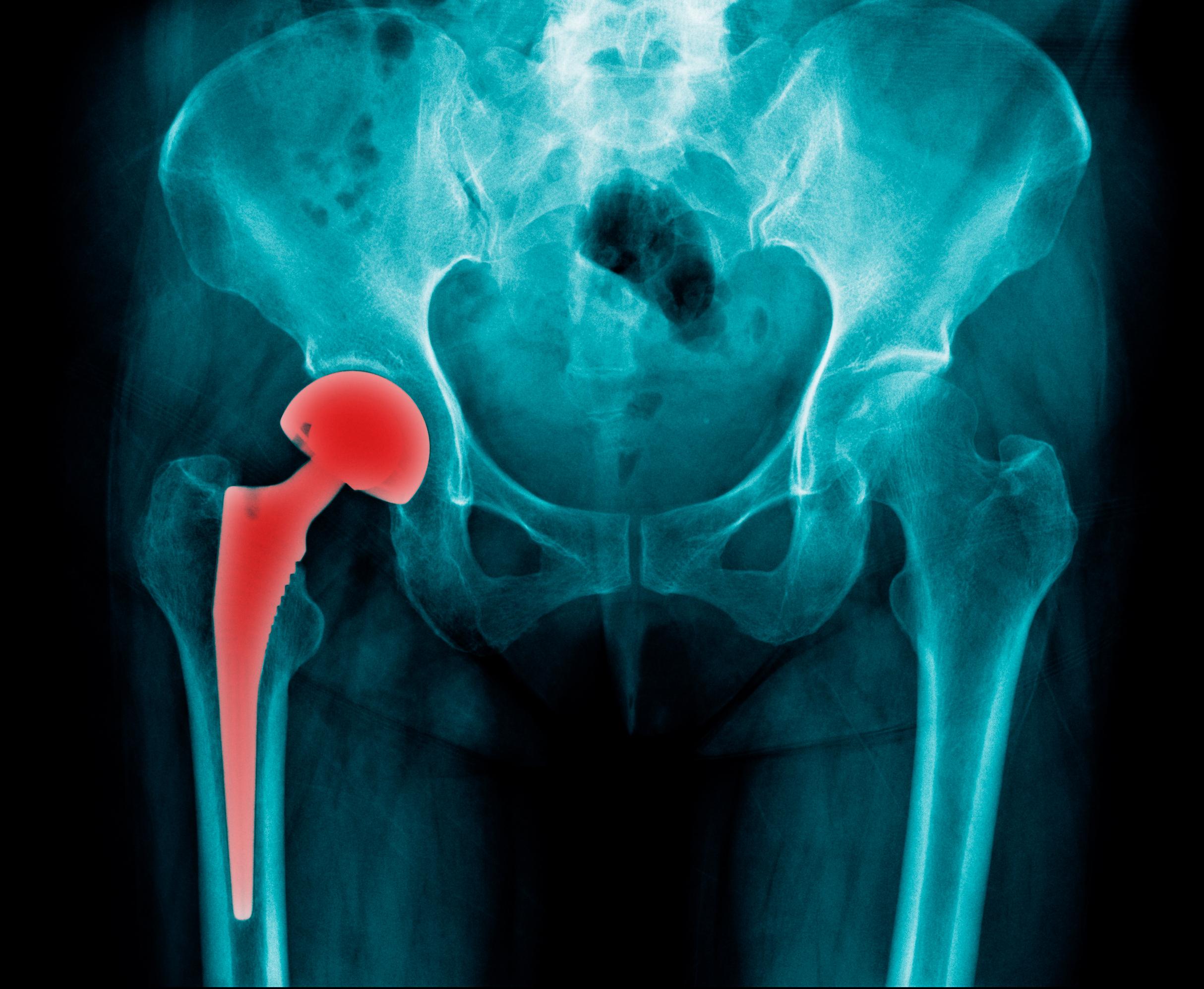 Hip arthoplasty | CHAPTER 11 | Orthopedic Nursing