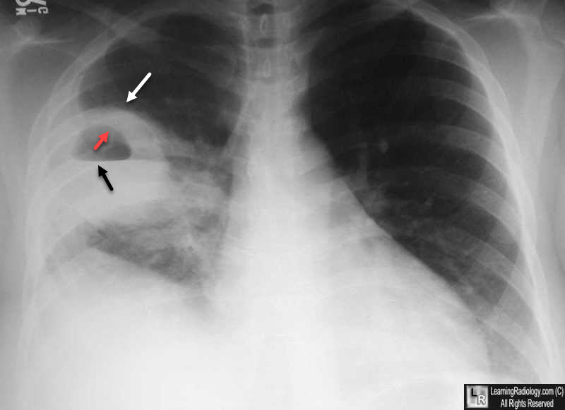 Lung Abscess | CHAPTER-8 | Medical and Surgical Nursing