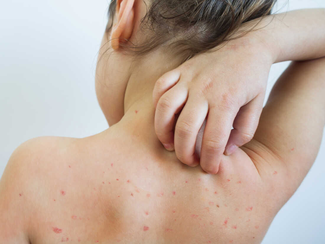 Definition of Measles | CHAPTER 6 | Pediatric Nursing