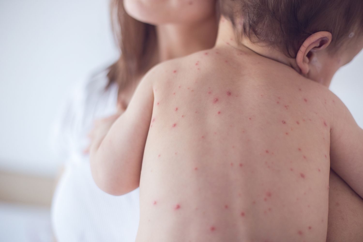 Definition of Measles | CHAPTER 6 | Pediatric Nursing