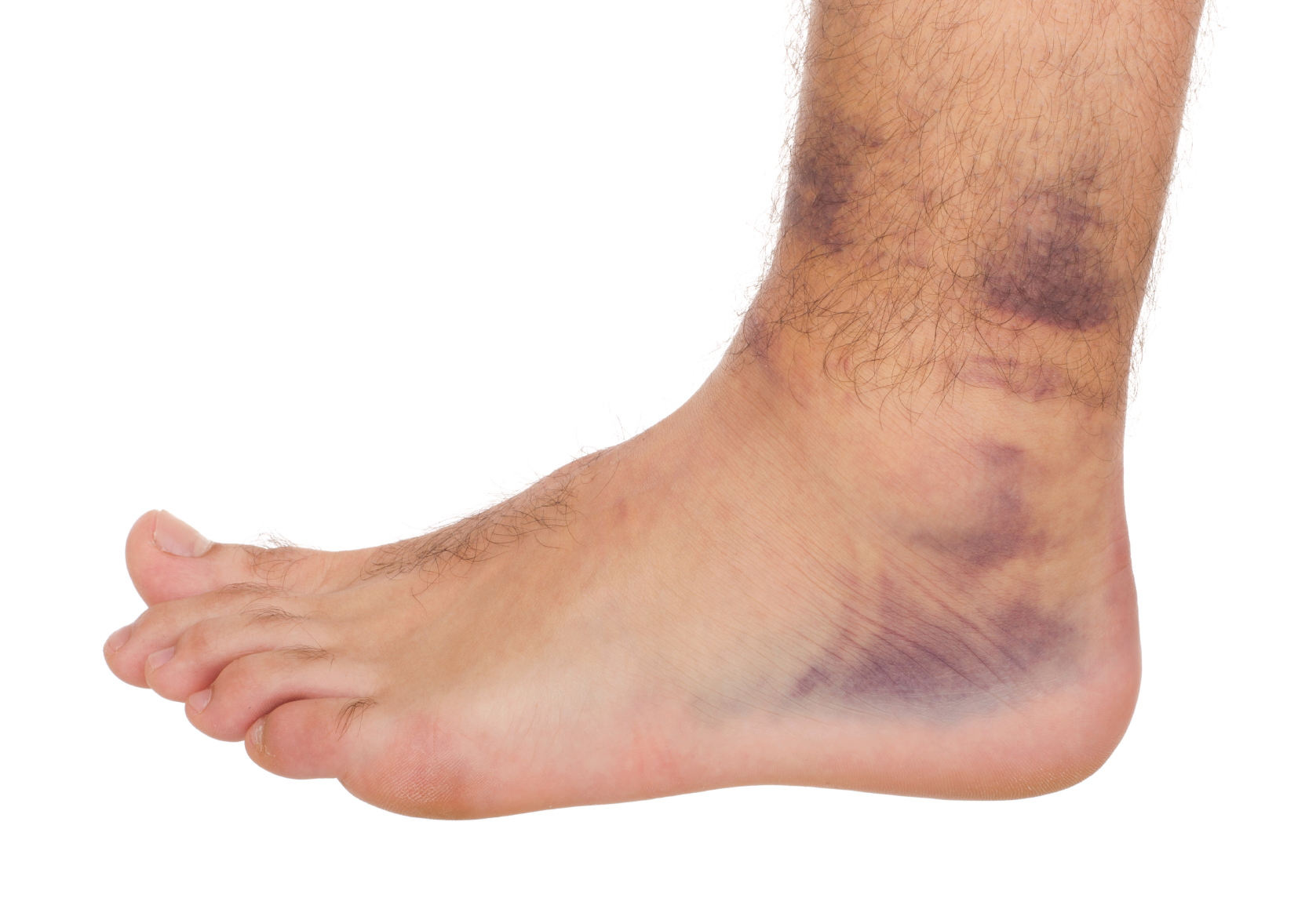 Soft tissue injury | CHAPTER 6 | Orthopedic Nursing