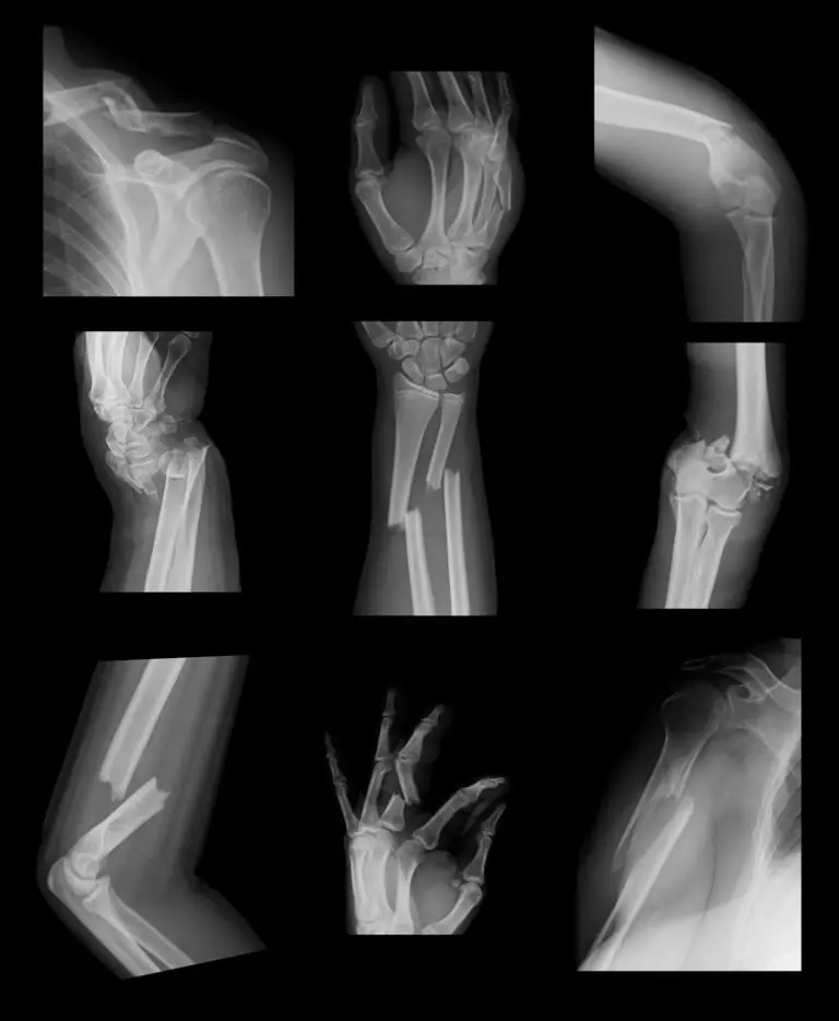 Definition of fracture | CHAPTER 5 | Orthopedic Nursing