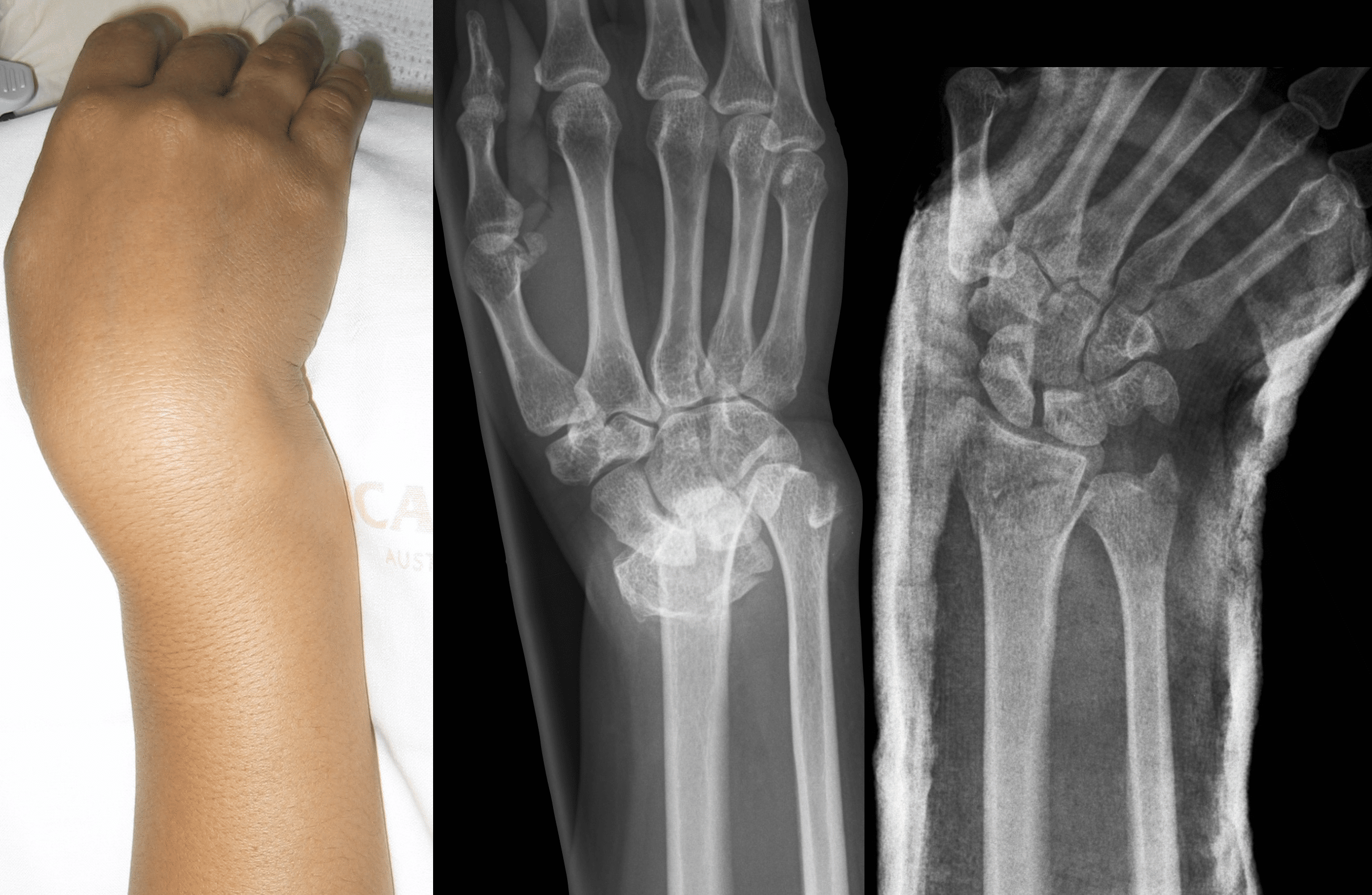 Definition of fracture | CHAPTER 5 | Orthopedic Nursing