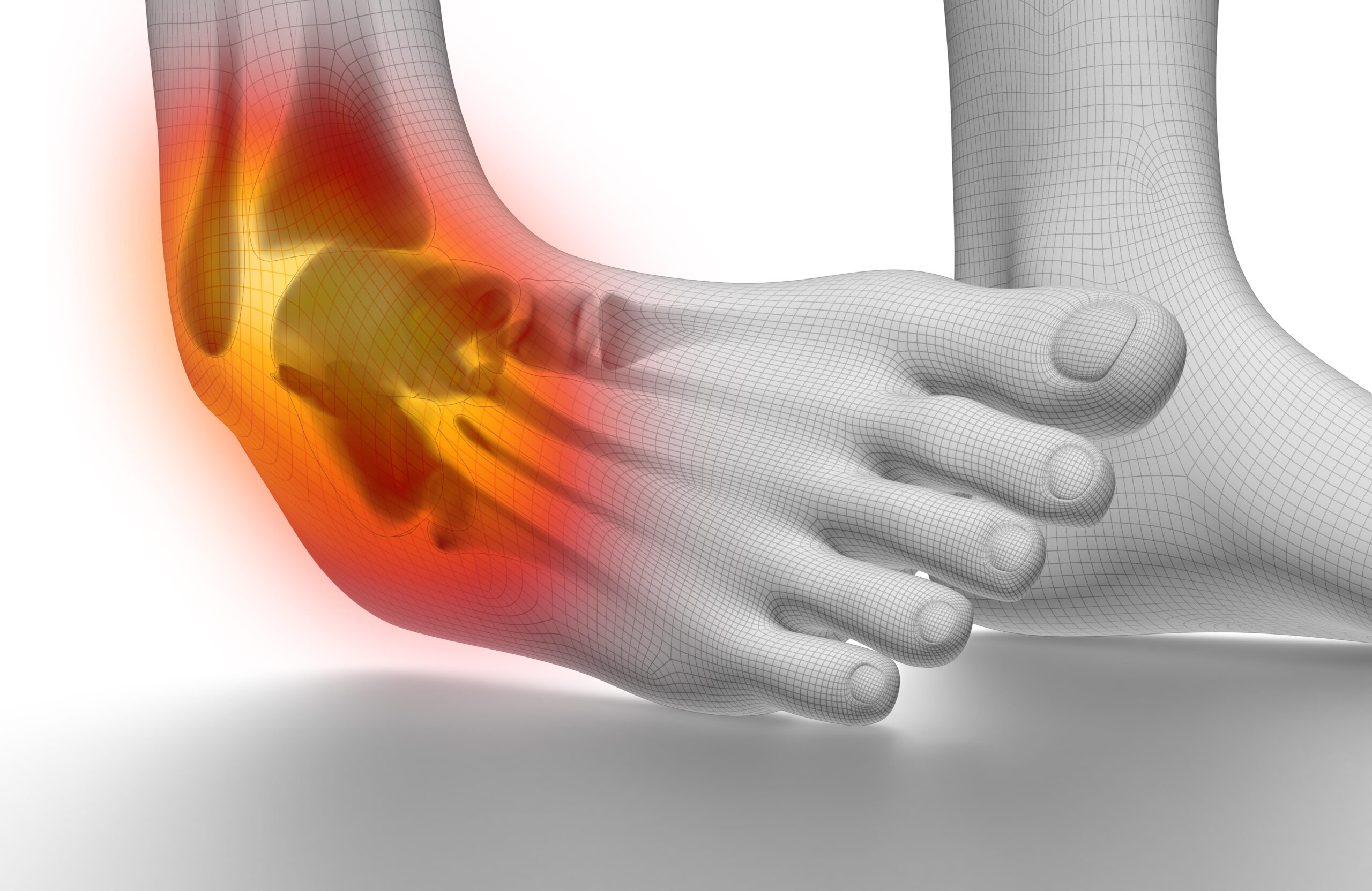 Definition of Sprain | CHAPTER 21 | Fundamentals of Nursing