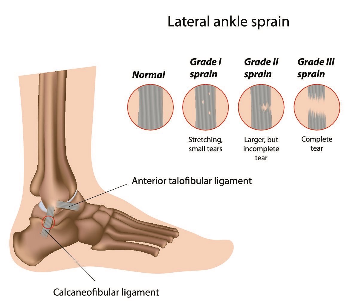 Definition of Sprain | CHAPTER 21 | Fundamentals of Nursing