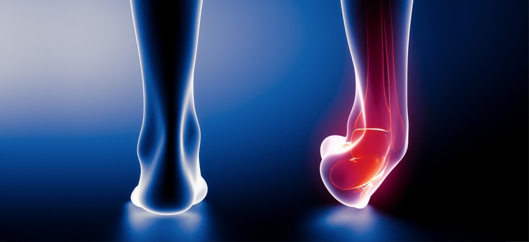 Definition of strain | CHAPTER 6 | Orthopedic Nursing