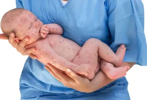 Definition of Rubella | Chapter 12 | Midwifery For Diploma In Nursing