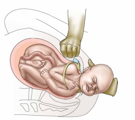 Shoulder dystocia | Chapter 17 | Midwifery For Diploma In Nursing