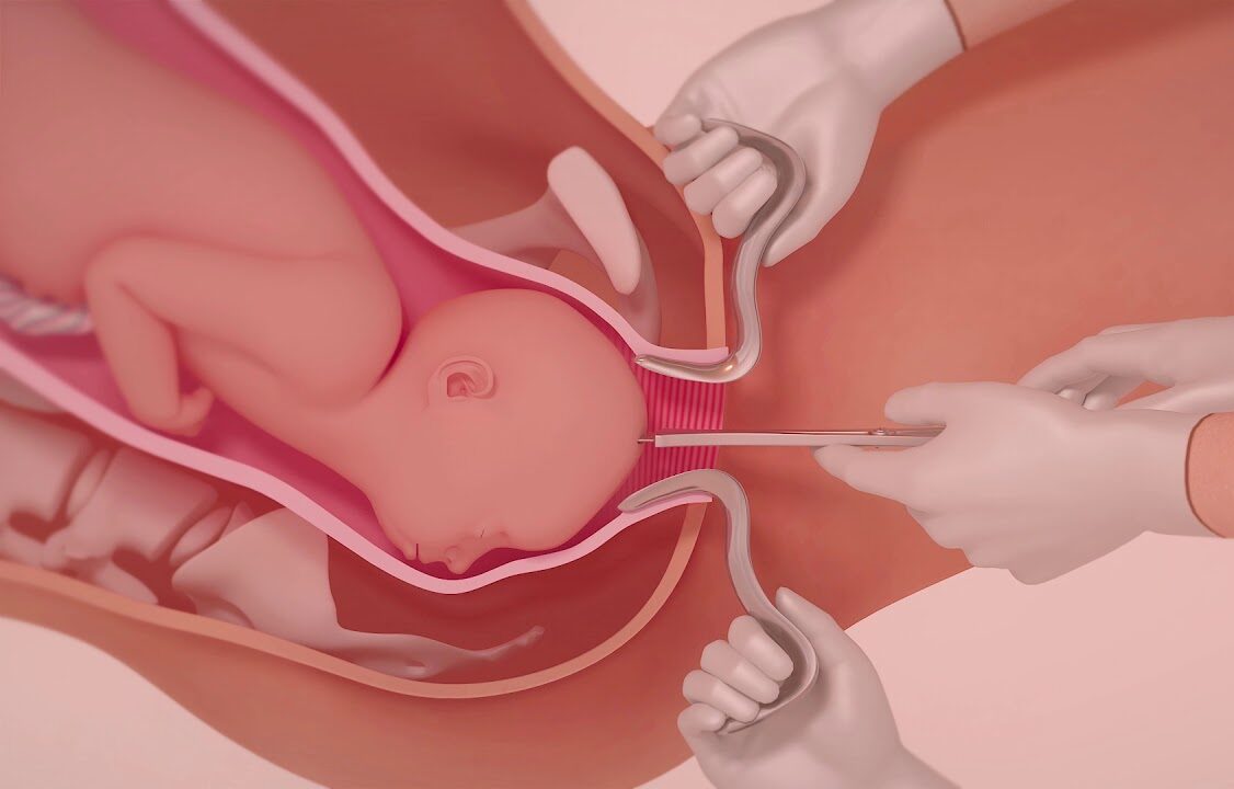 Destructive operations | Chapter 16 | Midwifery For Diploma In Nursing